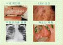 후천성 면역결핍증(AIDS) 18페이지