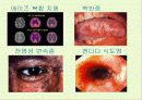 후천성 면역결핍증(AIDS) 19페이지