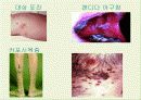 후천성 면역결핍증(AIDS) 20페이지