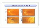 고혈압성 망막증 8페이지