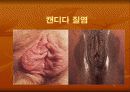 성인성 질환과 에이즈 6페이지
