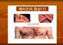 성인성 질환과 에이즈 13페이지