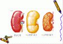 만성 신부전 발표용 파워포인트 입니다 7페이지