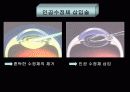 백내장 발표PPT 22페이지