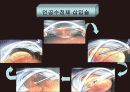백내장 발표PPT 23페이지