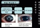 백내장 발표PPT 26페이지