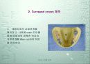 Dentech Positioner System을 이용한 Removable Partial denture 제작. 20페이지