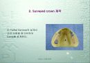 Dentech Positioner System을 이용한 Removable Partial denture 제작. 21페이지