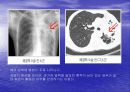 CHEST 질환 및 진단 11페이지