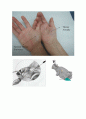 수근터널증후군(carpal tunnel syndrome) 2페이지