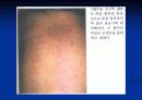 연소성 류마티스양 관절염 8페이지