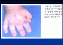 연소성 류마티스양 관절염 12페이지