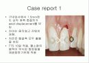 Splinting of traumatized teeth with a new device: TTS(Titanium Trauma Splint) 5페이지