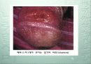 성병(Sexually Transmitted Diseases) 7페이지