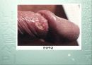 성병(Sexually Transmitted Diseases) 13페이지