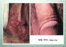 성병(Sexually Transmitted Diseases) 16페이지