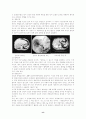 HCC 간세포암 case study 3페이지