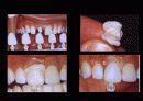 치기공 고정성 direct resin 의 구강외법 중 그 외법 9페이지