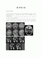 Dandy-Walker Syndrome : DWS CASE STUDY 4페이지