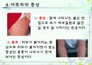 아토피성 피부염  5페이지