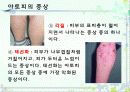 아토피성 피부염  7페이지