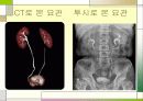 오줌요관(해부학, 요관결석, 이중요관) 4페이지