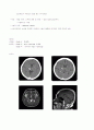Intracranial hemorrage CASE STUDY 4페이지