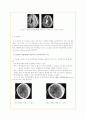 (case study) SDH,경막하혈종 4페이지
