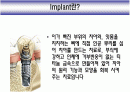 Implant(임플란트)에 대해 2페이지