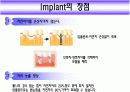 Implant(임플란트)에 대해 6페이지