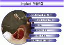 Implant(임플란트)에 대해 9페이지