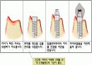 Implant(임플란트)에 대해 10페이지