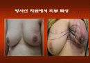 방사선 치료 합병증 관리 25페이지