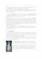 근골격계 질환 : 척추측만증(Scoliosis) 5페이지