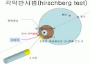 허쉬버그 검사 원리 (카파각  측정) 3페이지