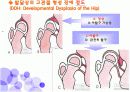 발달상 고관절 형성장애c(DDH)case study  5페이지