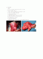 자궁근종(uterine myoma) 7페이지