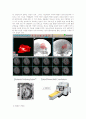 뇌출혈 (Arteriovenous malfomation, AVM) 4페이지