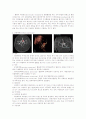뇌출혈 (Arteriovenous malfomation, AVM) 5페이지