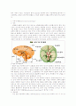 뇌출혈 (Arteriovenous malfomation, AVM) 10페이지
