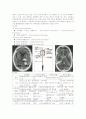 뇌출혈 (Arteriovenous malfomation, AVM) 11페이지