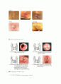 [간호학]치핵(hemorrhoids) 2페이지