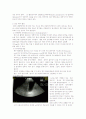 담석증 대상자의 간호사례연구 5페이지