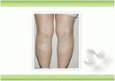 [교양] 무서운병, 하지정맥류에 대해서 ['A+레포트'] 13페이지