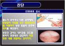 방광암 bladder cancer 18페이지