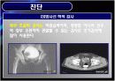 방광암 bladder cancer 19페이지