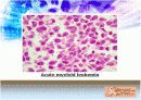 LeukemIa 백혈병 17페이지