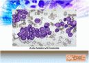 LeukemIa 백혈병 19페이지