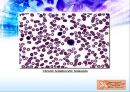 LeukemIa 백혈병 24페이지