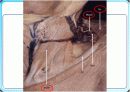 제 XI.뇌신경 Accessory nerve 4페이지